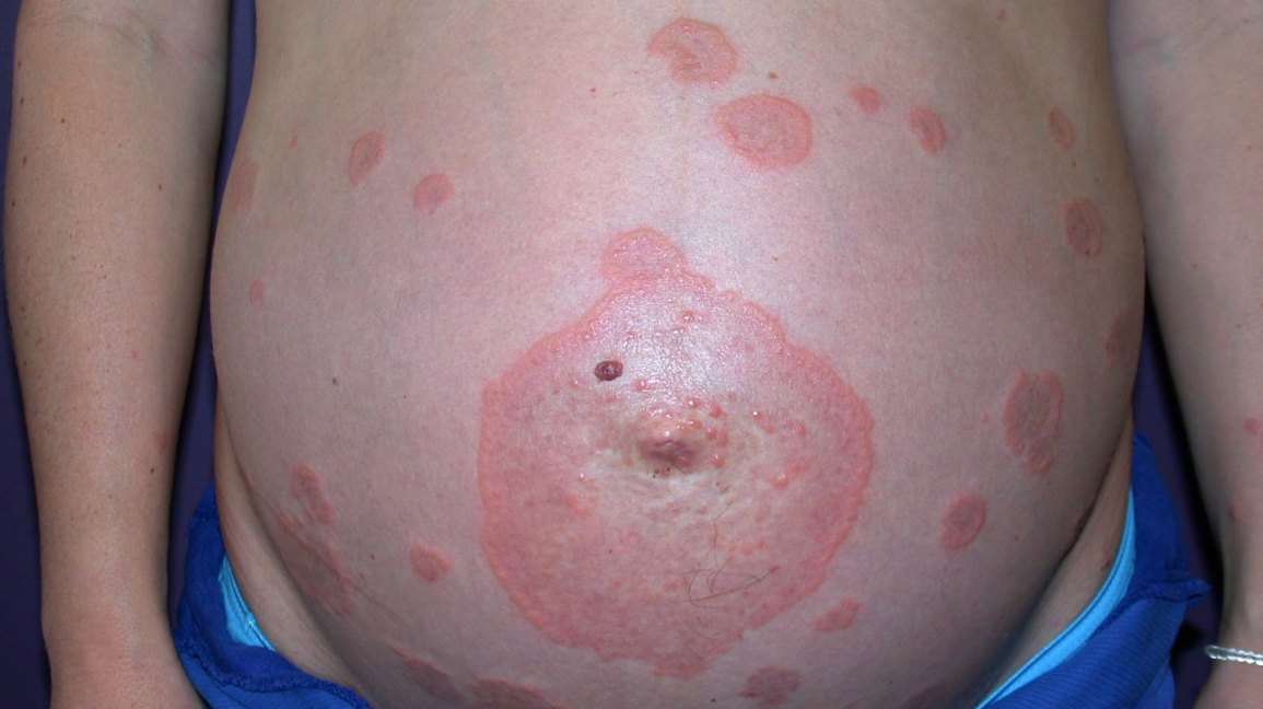 Pemphigoid Gestationis